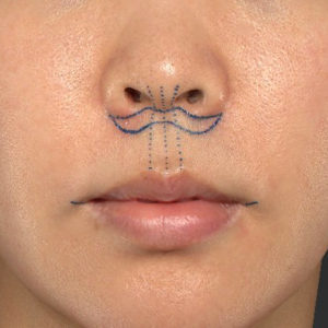 新宿ラクル美容外科クリニック　山本厚志　「人中短縮術（リップリフト）＋口角挙上（スマイルリップ）」　デザイン　６月２６日