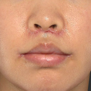 新宿ラクル美容外科クリニック　山本厚志　「人中短縮術（リップリフト）＋口角挙上（スマイルリップ）」　手術後１週間目　６月２６日