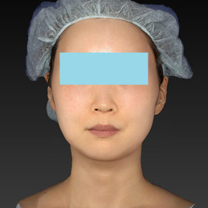 新宿ラクル美容外科クリニック　山本厚志　「アルテミスリフト」　手術後１ヶ月目　６月２１日