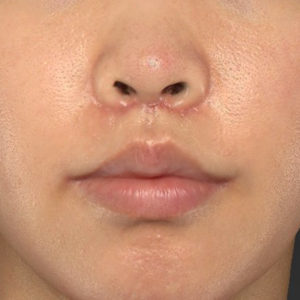 新宿ラクル美容外科クリニック　山本厚志　「人中短縮術（リップリフト）＋口角挙上（スマイルリップ）」　手術後１ヶ月目　６月２６日