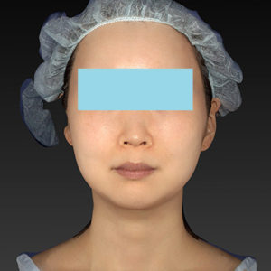 新宿ラクル美容外科クリニック　山本厚志　「アルテミスリフト」　手術後２ヶ月目　６月２１日