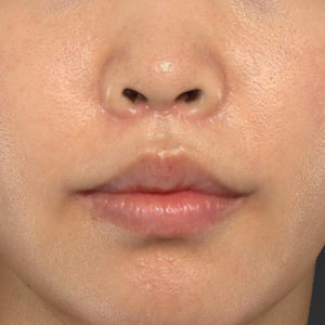 新宿ラクル美容外科クリニック　山本厚志　「人中短縮術（リップリフト）＋口角挙上（スマイルリップ）」　手術後２ヶ月目　６月２６日