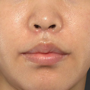新宿ラクル美容外科クリニック　山本厚志　「人中短縮術（リップリフト）＋口角挙上（スマイルリップ）」　手術後３ヶ月目　６月２６日