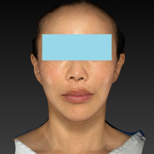 新宿ラクル美容外科クリニック　山本厚志　ナチュラルフェイスネックリフト　手術後３ヶ月目　７月２５日