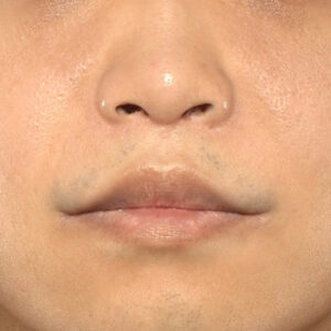 新宿ラクル美容外科クリニック　山本厚志　「鼻孔縁下降術＋人中短縮術（リップリフト）＋口角挙上（スマイルリップ）」　手術後６ヶ月目　１０月３日