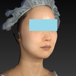 新宿ラクル美容外科クリニック　山本厚志　「アルテミスリフト」　手術前　６月２１日