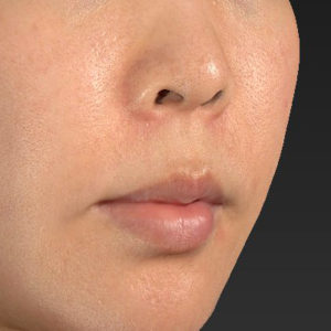 新宿ラクル美容外科クリニック　山本厚志　「人中短縮術（リップリフト）＋口角挙上（スマイルリップ）」　手術前　６月２６日