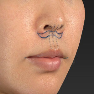 新宿ラクル美容外科クリニック　山本厚志　「人中短縮術（リップリフト）＋口角挙上（スマイルリップ）」　デザイン　６月２６日