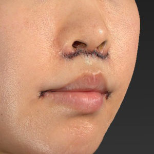 新宿ラクル美容外科クリニック　山本厚志　「人中短縮術（リップリフト）＋口角挙上（スマイルリップ）」　手術直後　６月２６日