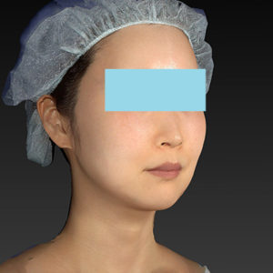 新宿ラクル美容外科クリニック　山本厚志　「アルテミスリフト」　手術後１ヶ月目　６月２１日