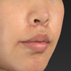 新宿ラクル美容外科クリニック　山本厚志　「人中短縮術（リップリフト）＋口角挙上（スマイルリップ）」　手術後１ヶ月目　６月２６日