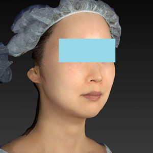 新宿ラクル美容外科クリニック　山本厚志　「アルテミスリフト」　手術後２ヶ月目　６月２１日