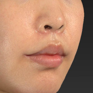 新宿ラクル美容外科クリニック　山本厚志　「人中短縮術（リップリフト）＋口角挙上（スマイルリップ）」　手術後２ヶ月目　６月２６日