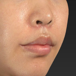 新宿ラクル美容外科クリニック　山本厚志　「人中短縮術（リップリフト）＋口角挙上（スマイルリップ）」　手術後３ヶ月目　６月２６日