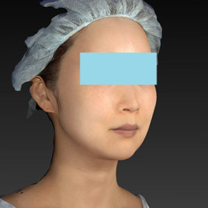 新宿ラクル美容外科クリニック　山本厚志　「アルテミスリフト」　手術後３ヶ月目　８月１３日