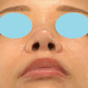 新宿ラクル美容外科クリニック　山本厚志　「鼻孔縁下降術」　手術後６ヶ月目　９月３０日