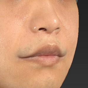 新宿ラクル美容外科クリニック　山本厚志　「鼻孔縁下降術＋人中短縮術（リップリフト）＋口角挙上（スマイルリップ）」　手術後６ヶ月目　１０月３日