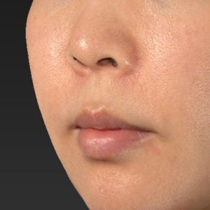 新宿ラクル美容外科クリニック　山本厚志　「人中短縮術（リップリフト）＋口角挙上（スマイルリップ）」　手術前　６月２６日