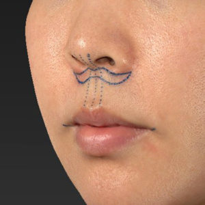 新宿ラクル美容外科クリニック　山本厚志　「人中短縮術（リップリフト）＋口角挙上（スマイルリップ）」　デザイン　６月２６日