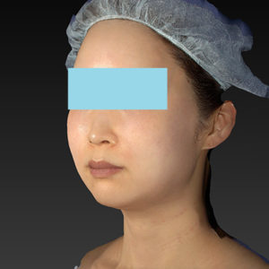 新宿ラクル美容外科クリニック　山本厚志　「アルテミスリフト」　手術直後　６月２１日