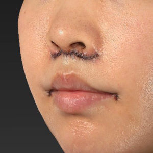 新宿ラクル美容外科クリニック　山本厚志　「人中短縮術（リップリフト）＋口角挙上（スマイルリップ）」　手術直後　６月２６日