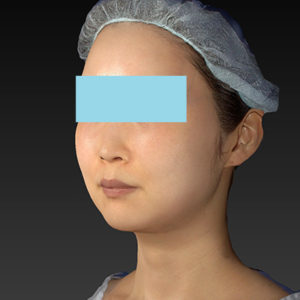 新宿ラクル美容外科クリニック　山本厚志　「アルテミスリフト」　手術後１週間目　６月２１日