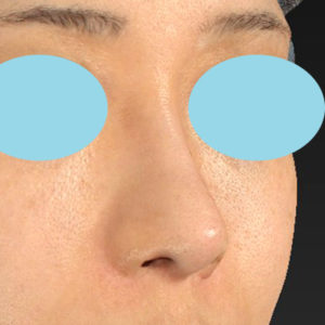 新宿ラクル美容外科クリニック　山本厚志　「小鼻縮小+α法 ＋ 鼻孔縁下降術」　手術後１２ヶ月目　８月１７日