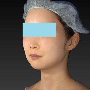 新宿ラクル美容外科クリニック　山本厚志　「アルテミスリフト」　手術後１ヶ月目　６月２１日