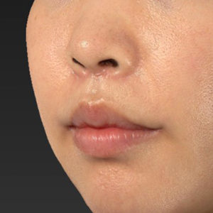 新宿ラクル美容外科クリニック　山本厚志　「人中短縮術（リップリフト）＋口角挙上（スマイルリップ）」　手術後２ヶ月目　６月２６日