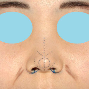 「耳介軟骨移植＋鼻尖縮小（close法）＋小鼻縮小+α」　新宿ラクル美容外科クリニック　２０代女性　デザイン　７月２３日