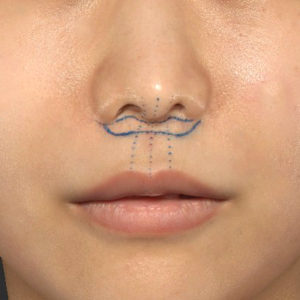 新宿ラクル美容外科クリニック　山本厚志　「人中短縮術（リップリフト）」　デザイン　７月２４日