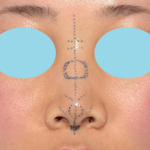 「耳介軟骨移植＋鼻尖縮小（close法）＋鼻プロテーゼ隆鼻術＋ハンプ切除＋猫手術＋真皮脂肪移植（鼻尖）」　新宿ラクル美容外科クリニック　２０代女性　デザイン　７月２６日