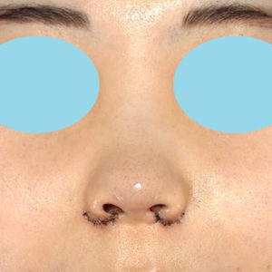 「耳介軟骨移植＋鼻尖縮小（close法）＋小鼻縮小+α」　新宿ラクル美容外科クリニック　２０代女性　手術直後　７月２３日