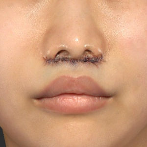 新宿ラクル美容外科クリニック　山本厚志　「人中短縮術（リップリフト）」　手術直後　７月２４日