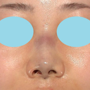 「耳介軟骨移植＋鼻尖縮小（close法）＋鼻プロテーゼ隆鼻術＋ハンプ切除＋猫手術＋真皮脂肪移植（鼻尖）」　新宿ラクル美容外科クリニック　２０代女性　手術直後　７月２６日