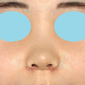 「耳介軟骨移植＋鼻尖縮小（close法）＋小鼻縮小+α」　新宿ラクル美容外科クリニック　２０代女性　手術後１週間目　７月２３日