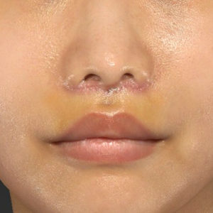 新宿ラクル美容外科クリニック　山本厚志　「人中短縮術（リップリフト）」　手術後１週間目　７月２４日