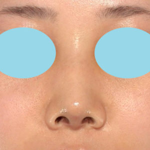 「耳介軟骨移植＋鼻尖縮小（close法）＋鼻プロテーゼ隆鼻術＋ハンプ切除＋猫手術＋真皮脂肪移植（鼻尖）」　新宿ラクル美容外科クリニック　２０代女性　手術後１週間目　７月２６日