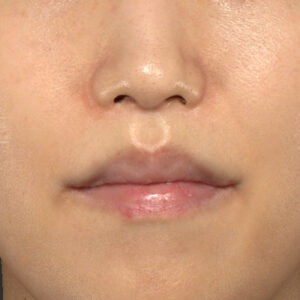 新宿ラクル美容外科クリニック　山本厚志　「人中短縮術（リップリフト）＋口角挙上（スマイルリップ）」　手術後１２ヶ月目　１月９日
