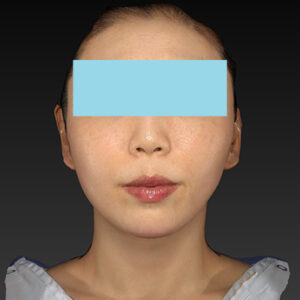 新宿ラクル美容外科クリニック　山本厚志　「ナチュラルフェイスネックリフト」「ライポライフ脂肪吸引（ジョールファット+あご下）」　手術後１２ヶ月目　１月２１日