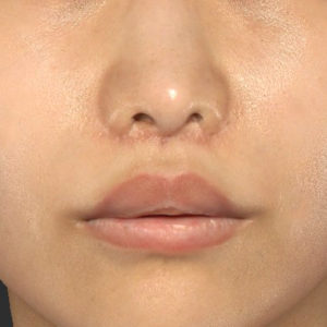 新宿ラクル美容外科クリニック　山本厚志　「人中短縮術（リップリフト）」　手術後１ヶ月目　７月２４日