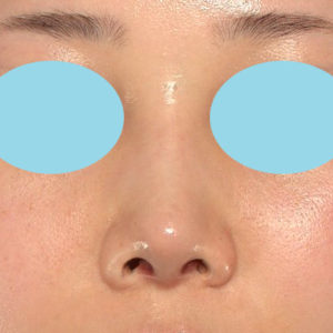 「耳介軟骨移植＋鼻尖縮小（close法）＋鼻プロテーゼ隆鼻術＋ハンプ切除＋猫手術＋真皮脂肪移植（鼻尖）」　新宿ラクル美容外科クリニック　２０代女性　手術後１ヶ月目　７月２６日