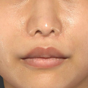 新宿ラクル美容外科クリニック　山本厚志　「人中短縮術（リップリフト）」　手術後３ヶ月目　７月２４日