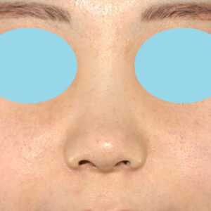 「耳介軟骨移植＋鼻尖縮小（close法）＋小鼻縮小+α」　新宿ラクル美容外科クリニック　２０代女性　手術後３ヶ月目　８月３１日