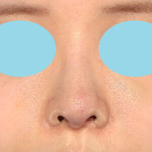 「鼻中隔延長修正＋耳介軟骨移植修正＋鼻尖形成修正＋小鼻縮小＋α法修正＋鼻柱下降＋猫手術＋真皮脂肪移植（鼻尖）」　新宿ラクル美容外科クリニック　２０代女性　手術後６ヶ月目　１０月１日