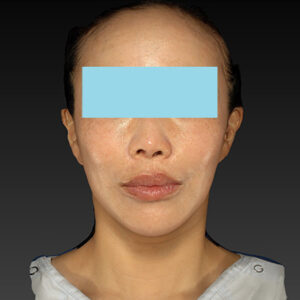 新宿ラクル美容外科クリニック　山本厚志　ナチュラルフェイスネックリフト　手術後６ヶ月目　１月１９日