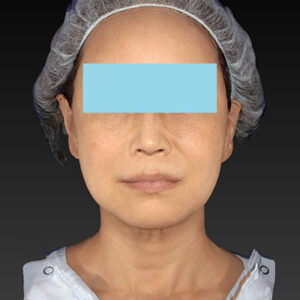 新宿ラクル美容外科クリニック　山本厚志　「アルテミスリフト」　手術後６ヶ月目　１月２５日