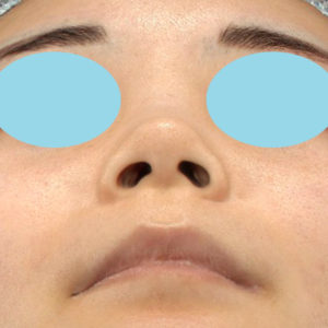 「耳介軟骨移植＋鼻尖縮小（close法）＋小鼻縮小+α」　新宿ラクル美容外科クリニック　２０代女性　手術前　７月２３日