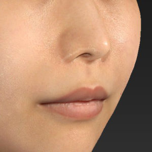 新宿ラクル美容外科クリニック　山本厚志　「人中短縮術（リップリフト）」　手術前　７月２４日