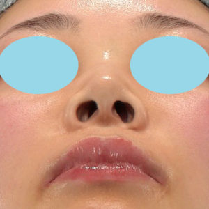 「耳介軟骨移植＋鼻尖縮小（close法）＋鼻プロテーゼ隆鼻術＋ハンプ切除＋猫手術＋真皮脂肪移植（鼻尖）」　新宿ラクル美容外科クリニック　２０代女性　手術前　７月２６日